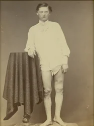 Soldado herido de la Guerra Civil (Charles Westerfield, Museo Médico del Ejército, Especimen No. 4278), abril de 1865